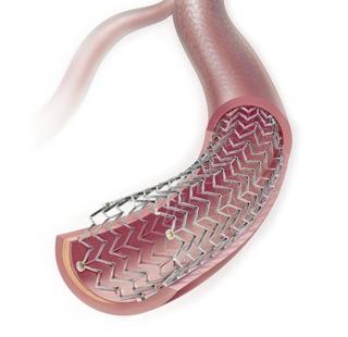 FDA Panel Gives Unanimous Nod to Cook Medical's Zilver PTX Drug